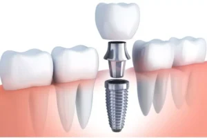 dental implants dental