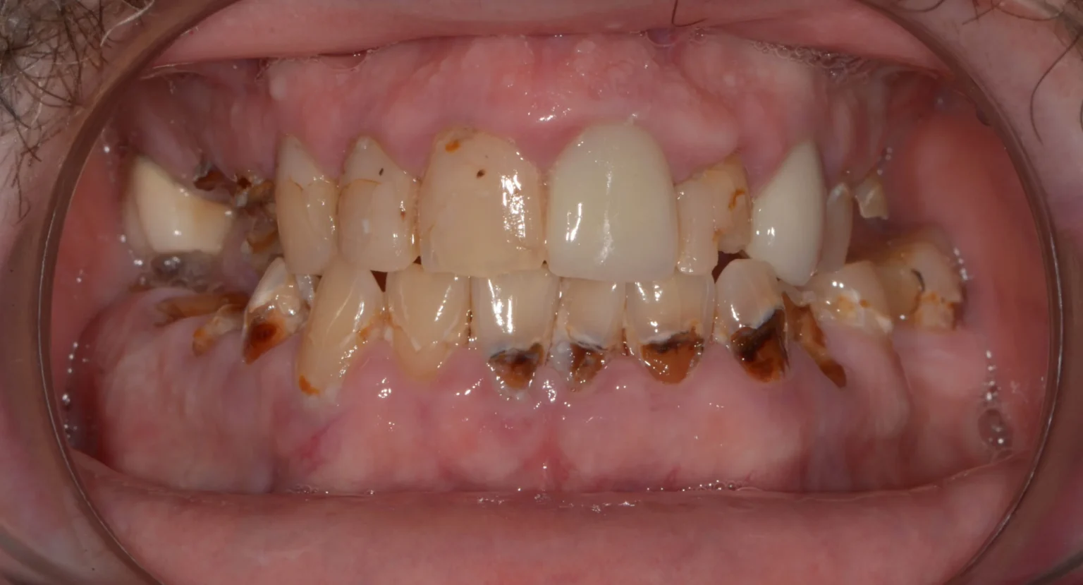 Do they put you to sleep when they pull all your teeth for dentures?