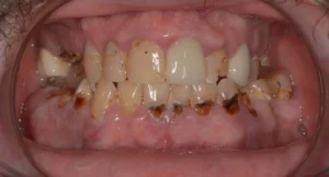 Do they put you to sleep when they pull all your teeth for dentures?