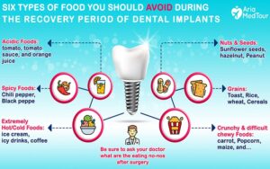 What foods not to eat after dental implants?