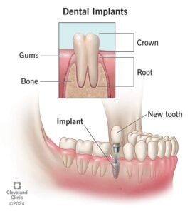 implant teeth operation