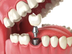 teeth replacement