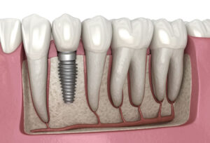 dental implantation