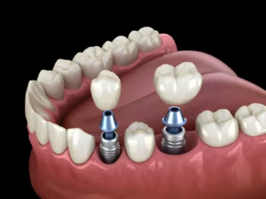 Are you awake during full dental implants?