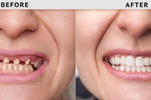 Do you have no teeth while waiting for implants?