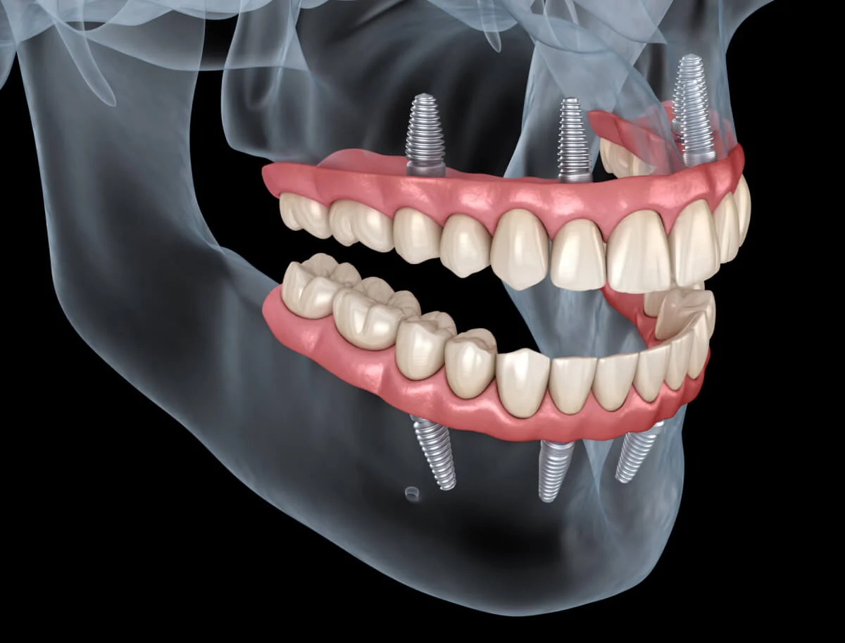 Can I eat normally with All-on-4 dental implants?