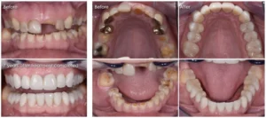 How to fix your teeth when you're poor?