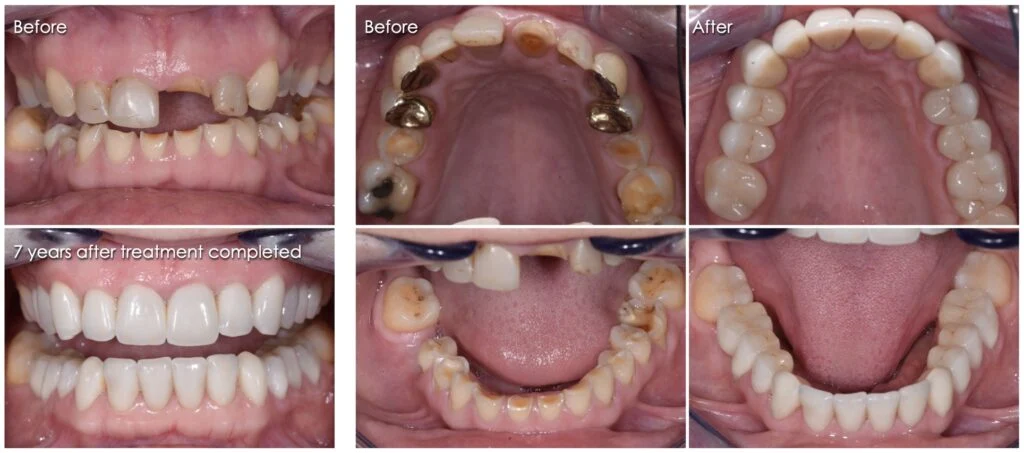 How to fix your teeth when you're poor?