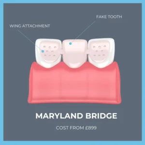 How much does a dental bridge cost in the UK?