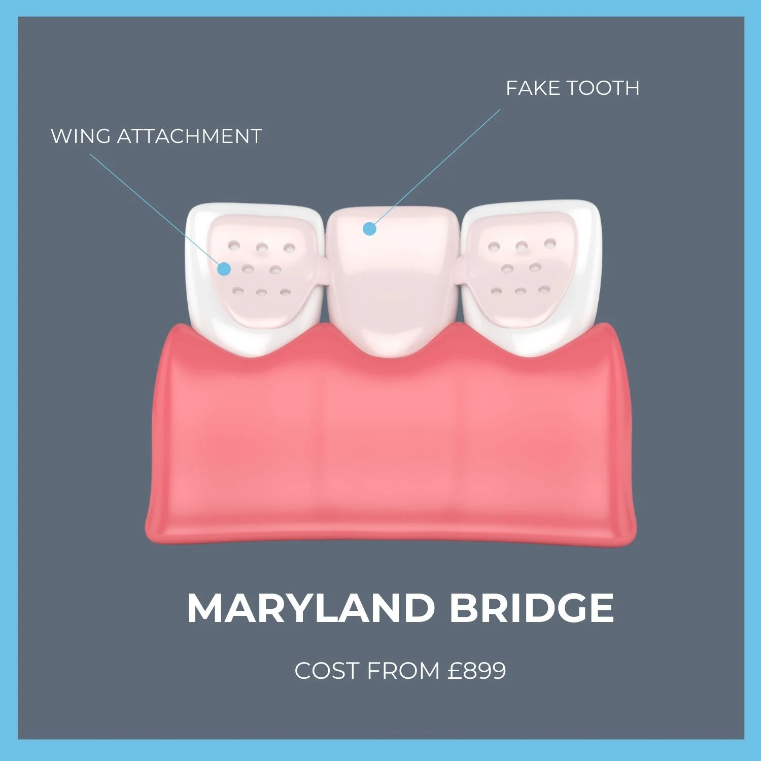 How much does a dental bridge cost in the UK?