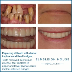 How long does it take to remove all teeth and get implants?
