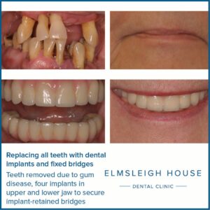 Can I have all my teeth removed and replaced with implants in the UK?