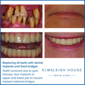Can I have all my teeth removed and replaced with implants?