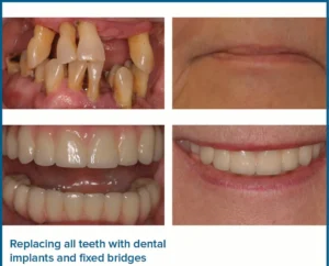 i want all my teeth removed and replaced uk