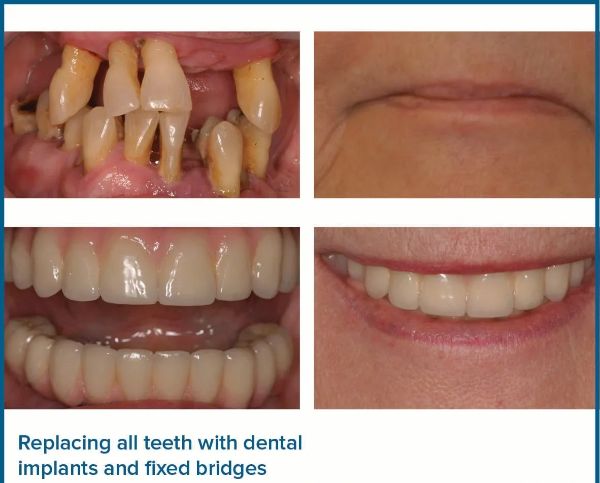 i want all my teeth removed and replaced uk