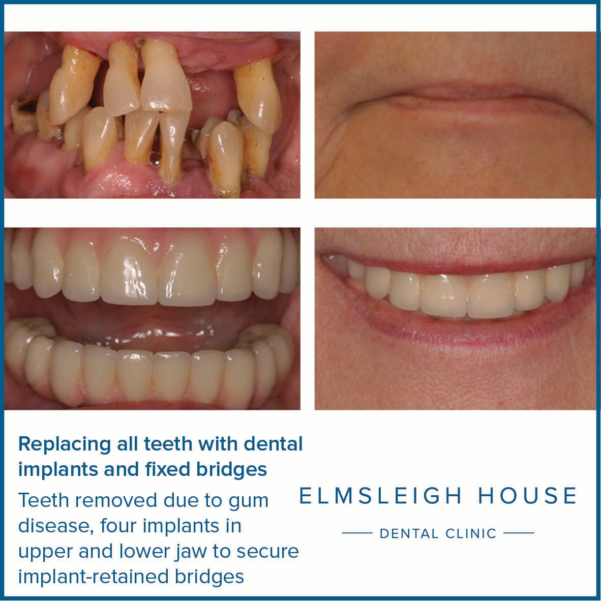 Can I have all my teeth removed and replaced with implants in the UK?