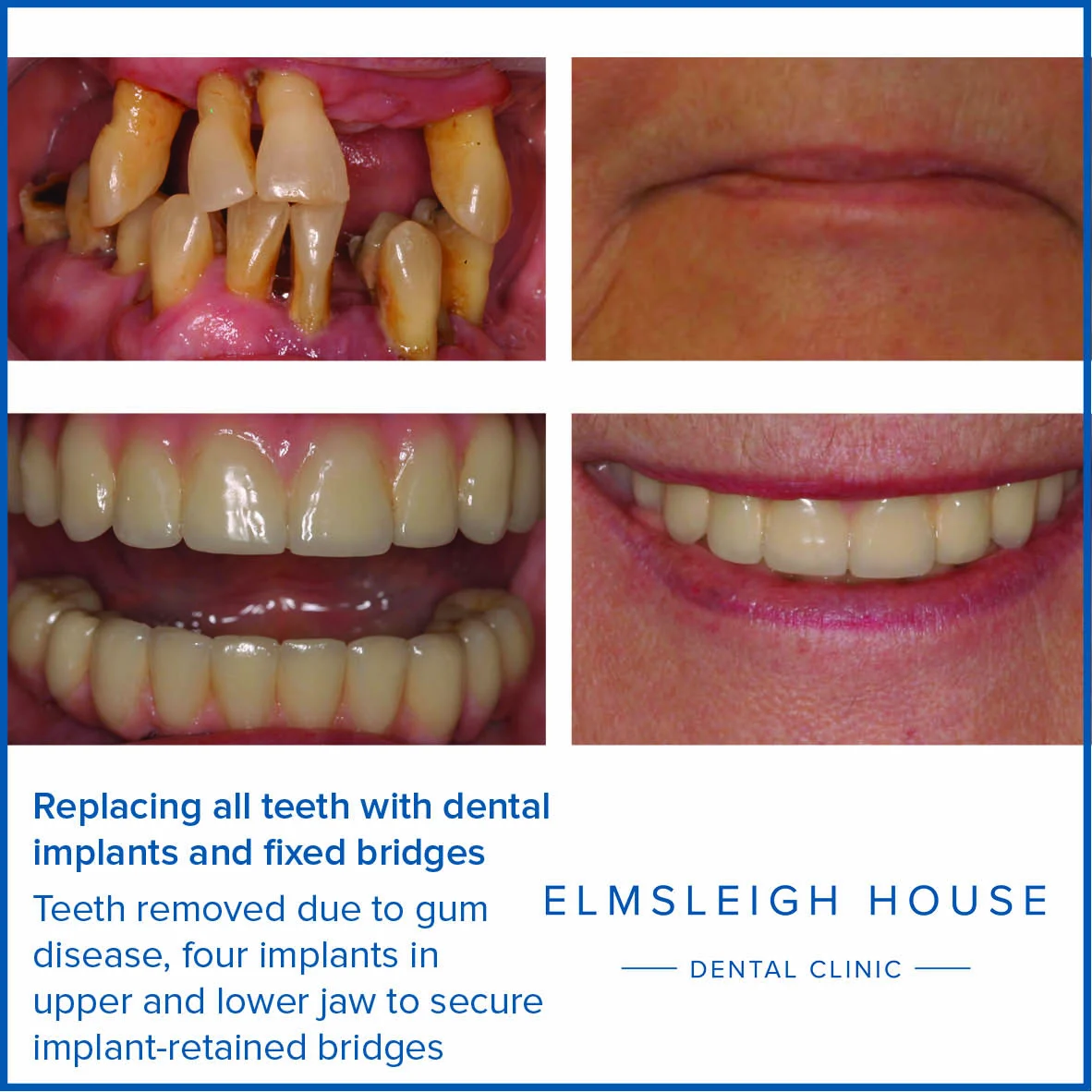 Can I have all my teeth removed and replaced with implants?