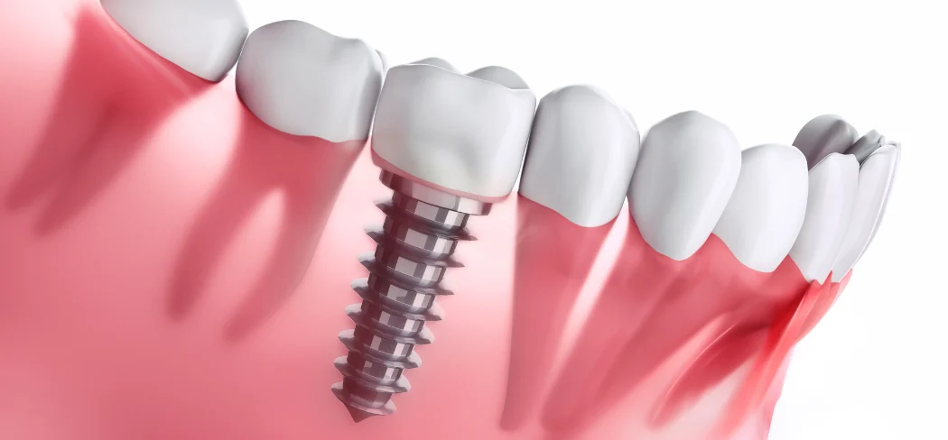 Who should not get dental implants?