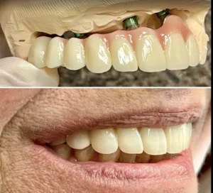 Do full mouth implants feel like real teeth?