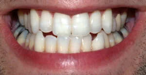 full set of teeth