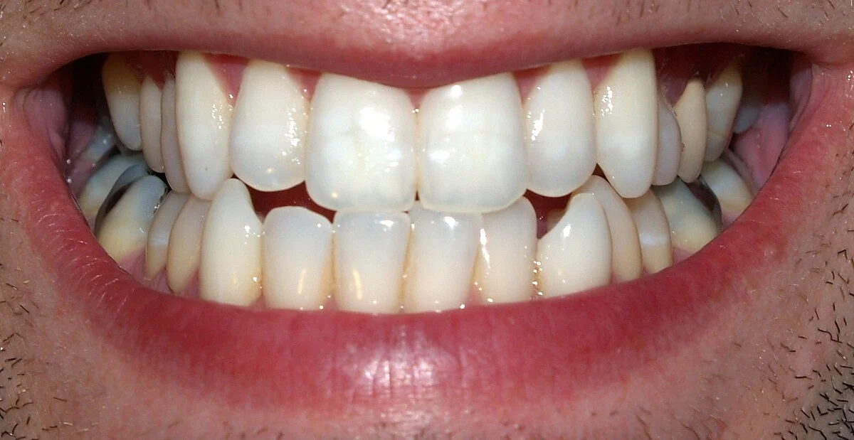 full set of teeth