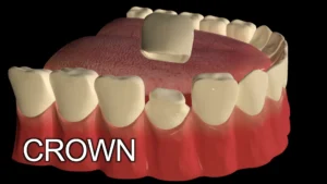 What is the downside of a tooth crown?