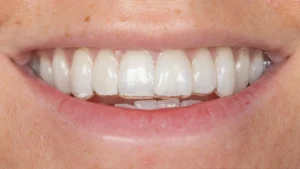 What is the cheapest way to fix messed up teeth?