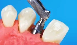 What not to do before a dental implant?