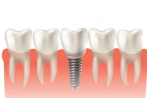 Who is a poor candidate for dental implants?