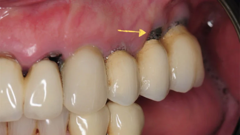 Why is my dental implant turning black
