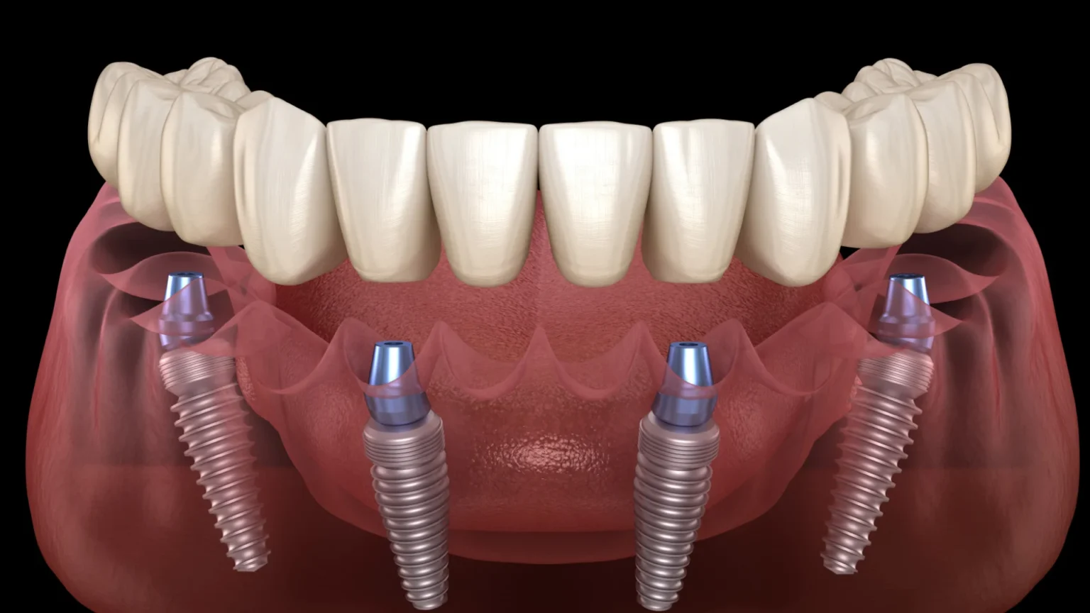 all in 4 dental implants