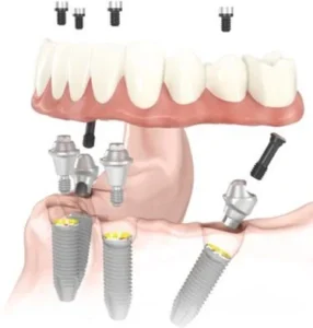 Can All-on-4 implants become loose?