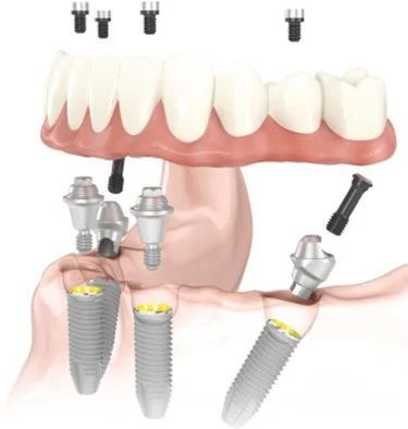 Can All-on-4 implants become loose?