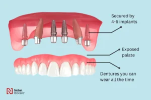 Is it hard to talk with all four dental implants?