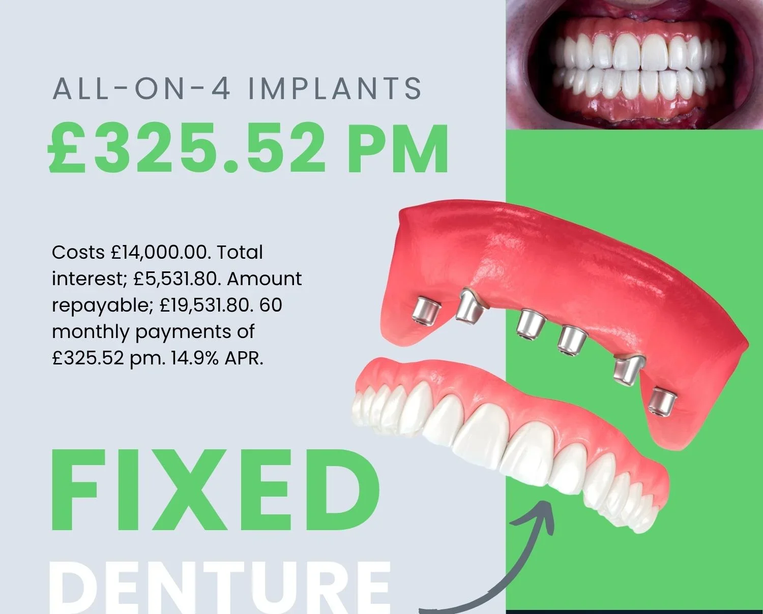 What is the most dental implants can cost?