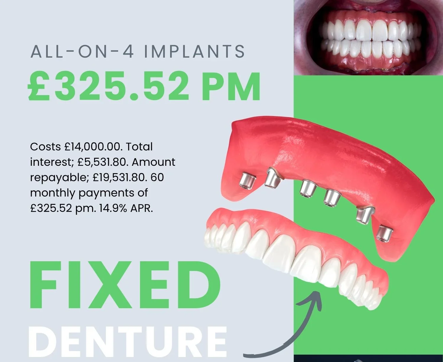 How much will an implant tooth cost?