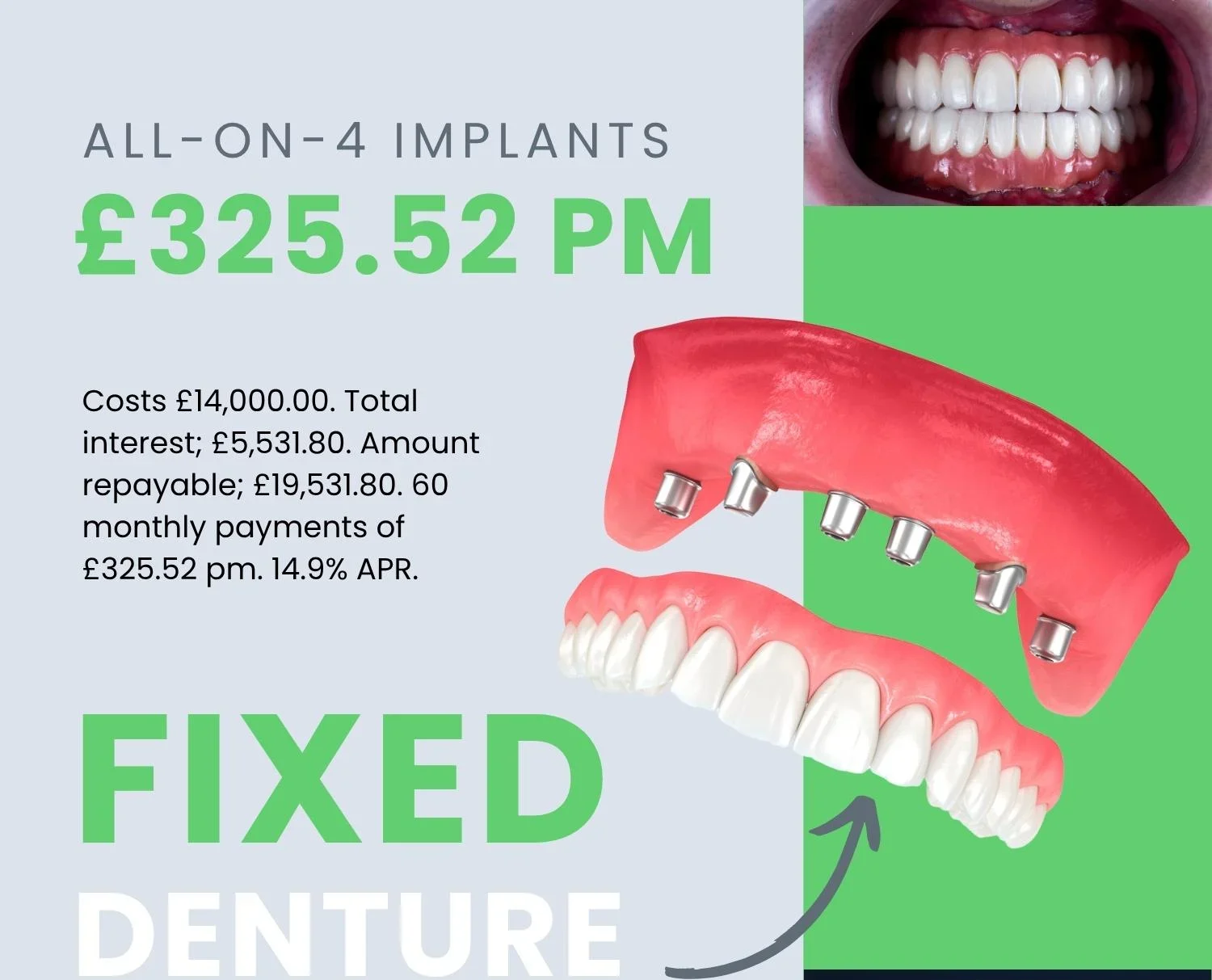 dental implants cost