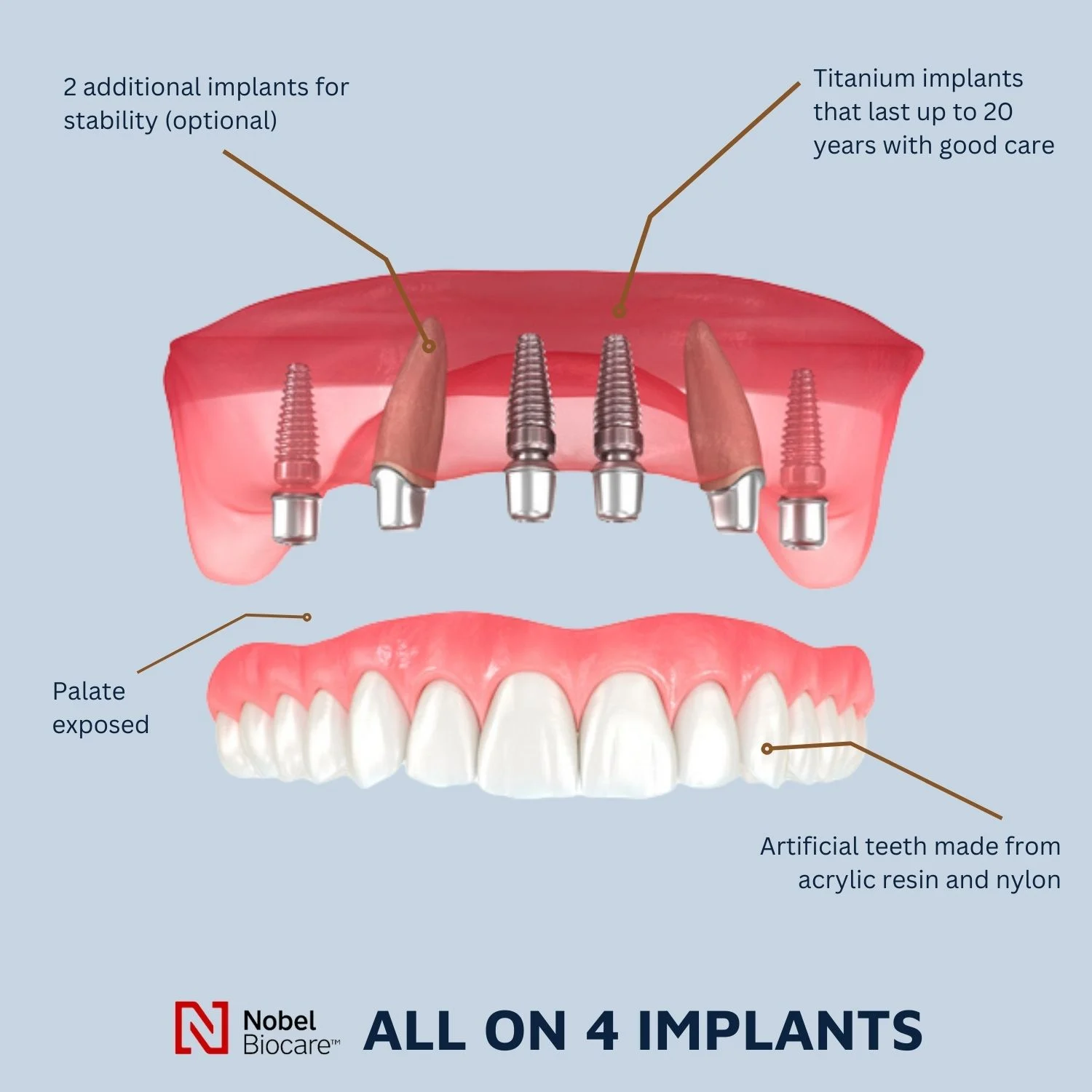 What is the average UK price for full dental implants?