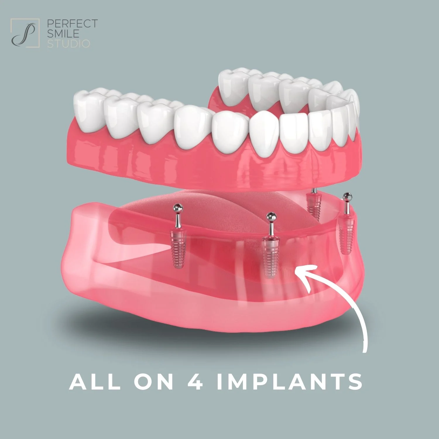 Can I get All-on-4 implants on the NHS?