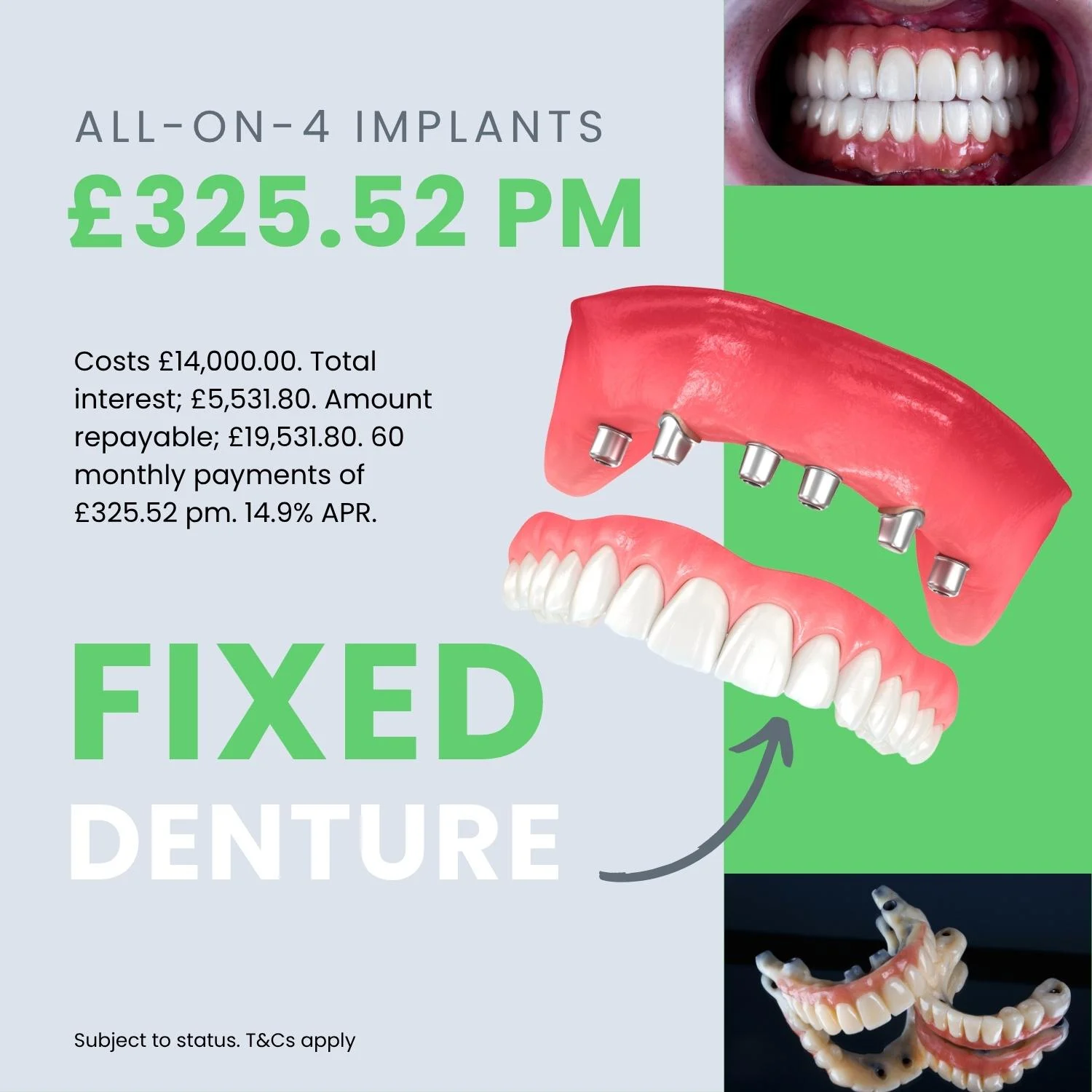 How much is All-on-4 dental implants in the UK?