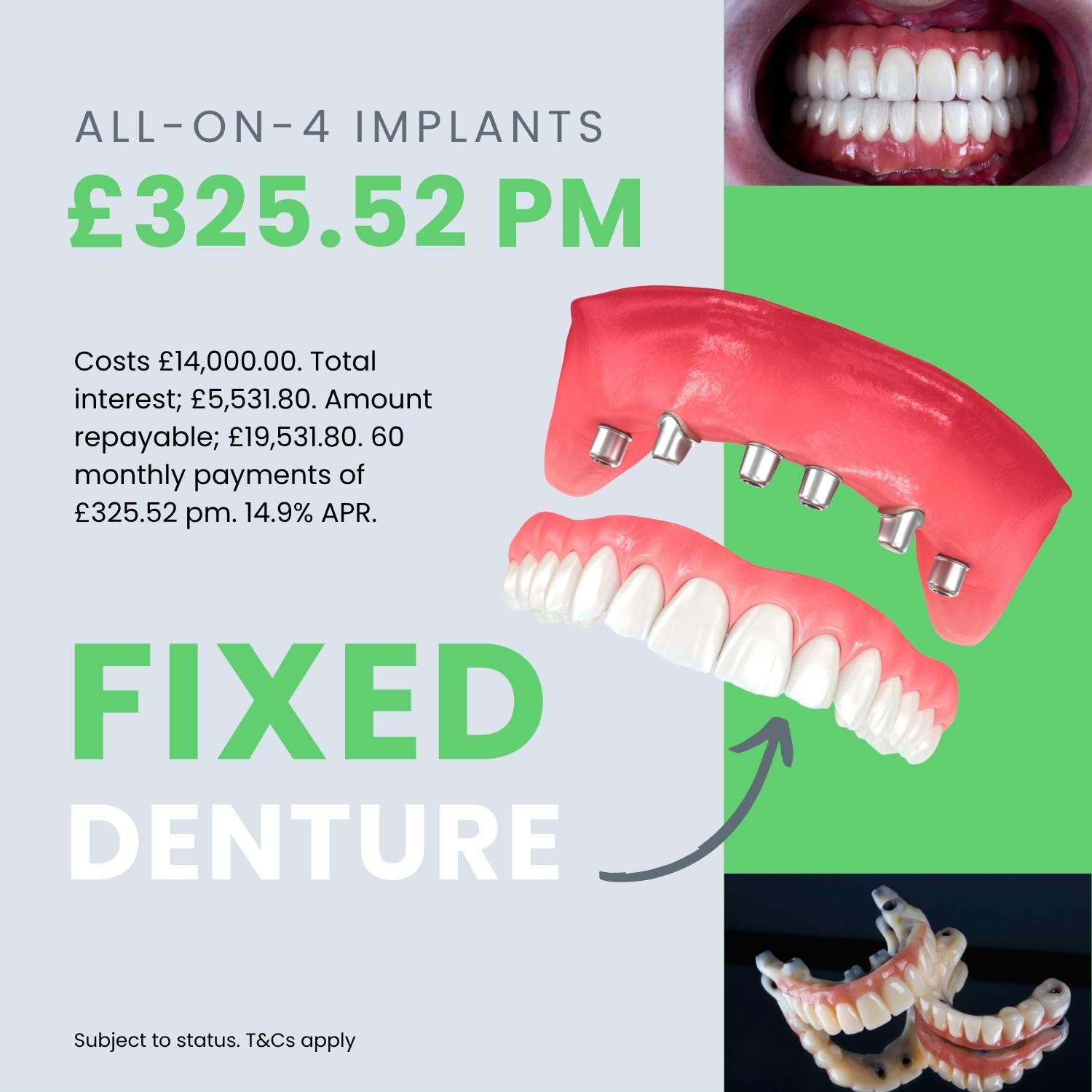 How much does a dental implant cost in the UK?
