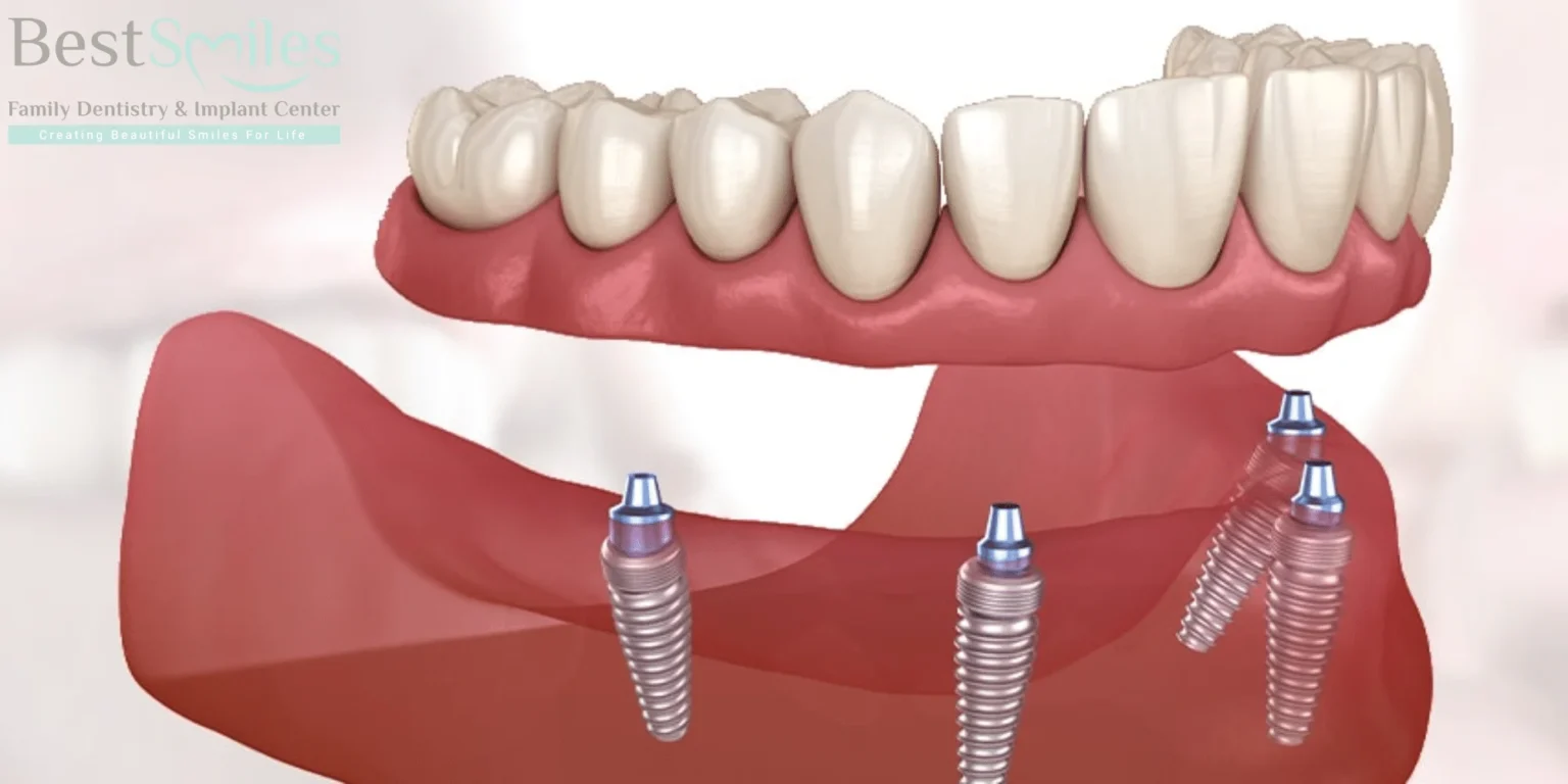 How painful is All-on-4 dental implants?