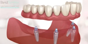 How painful is All-on-4 dental implants?