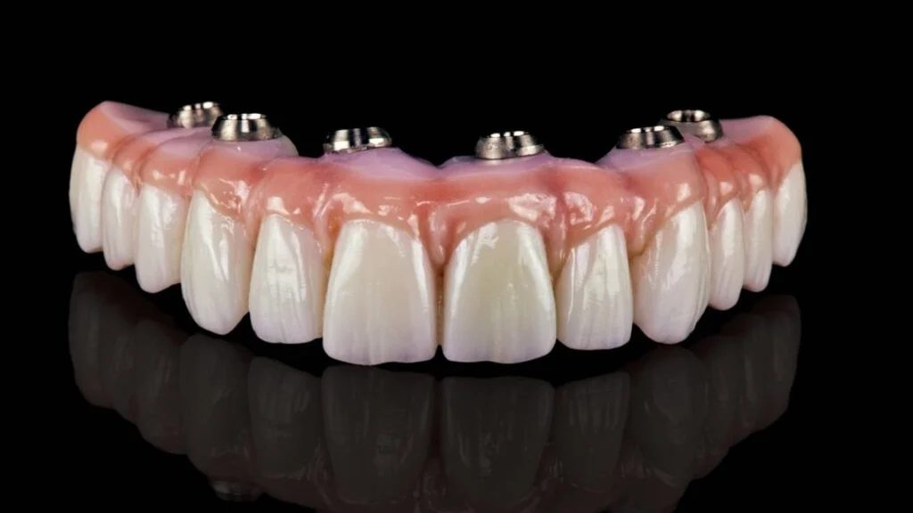 How long does All-on-4 implants last?