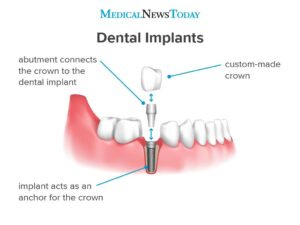 what are implants