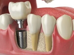 tooth replacement