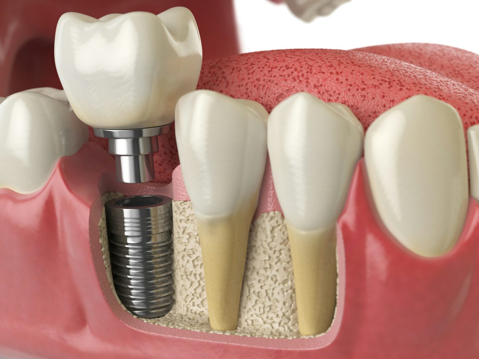 implants teeth
