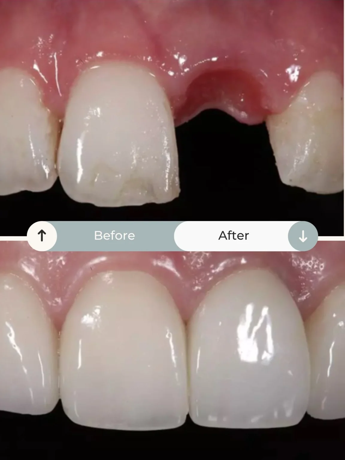 How many implants for two missing teeth?