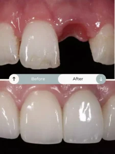 How many implants for two missing teeth?