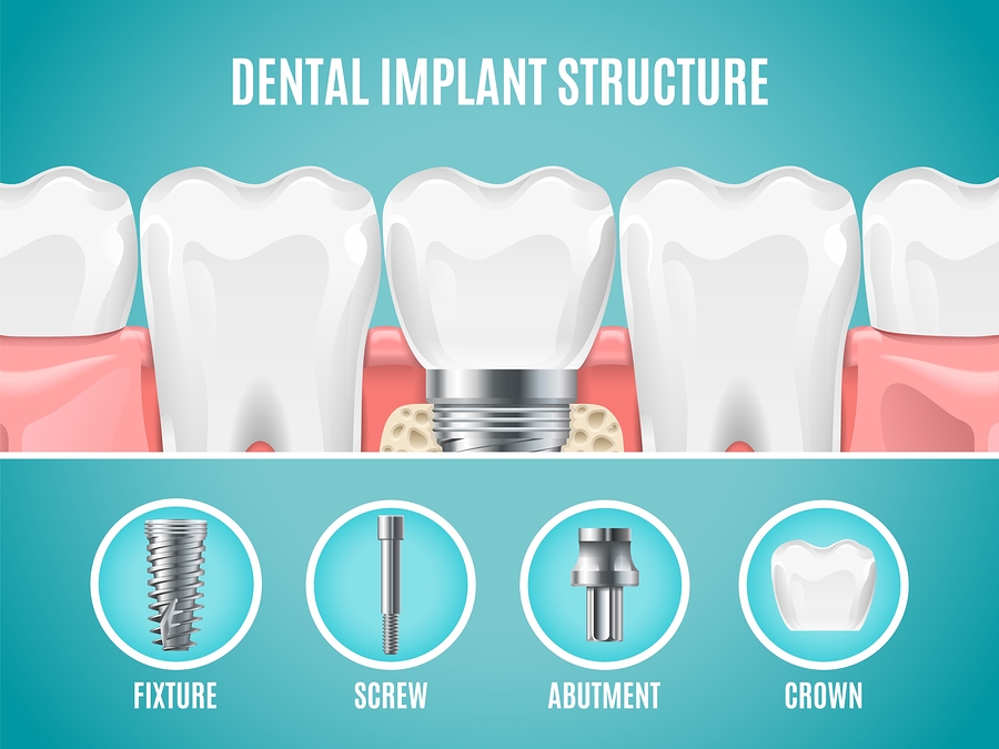 dentist implants